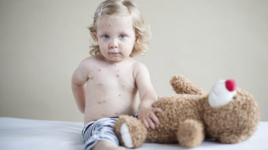 Vaccin contre la varicelle: moins d'enfants hospitalisés 