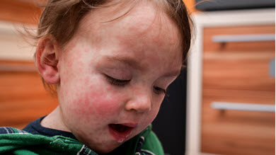Cas de rougeole: appel à la vaccination pour stopper la progression